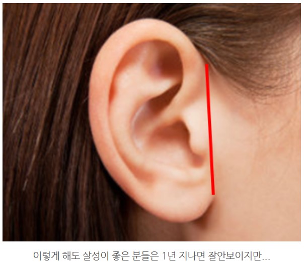 안면거상 수술 흉터, 1개월 차에도 이렇게 안 보일 수 있습니다. 관련 이미지 1