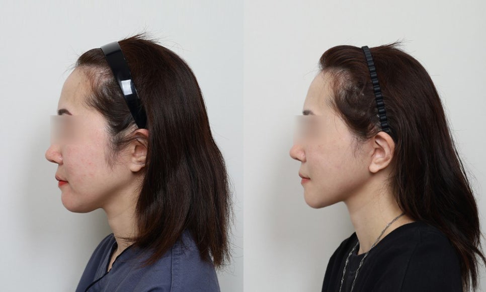 윤곽수술 후 생길 수 있는 관련 이미지 7