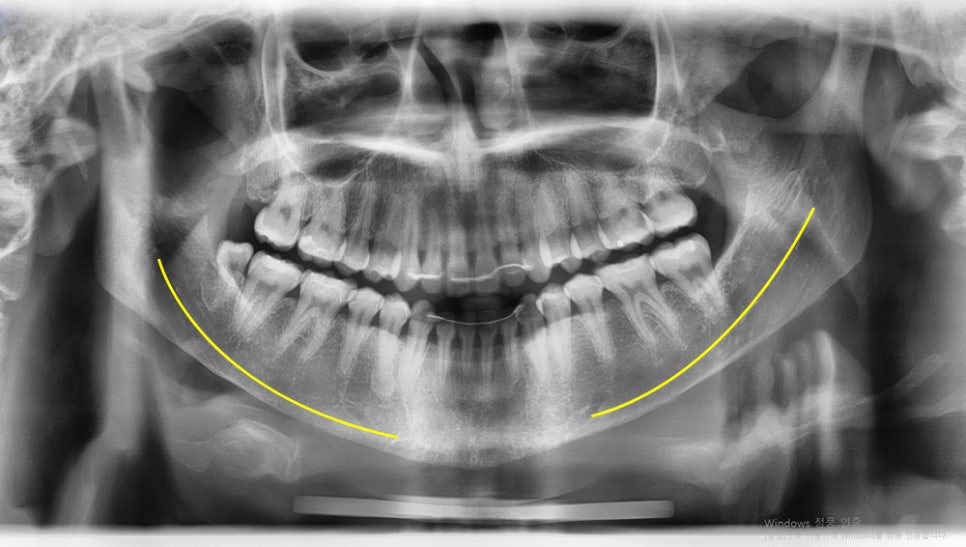 What Should Be the Top Priority in Facial Contouring Surgery: Effectiveness or Safety? image 5