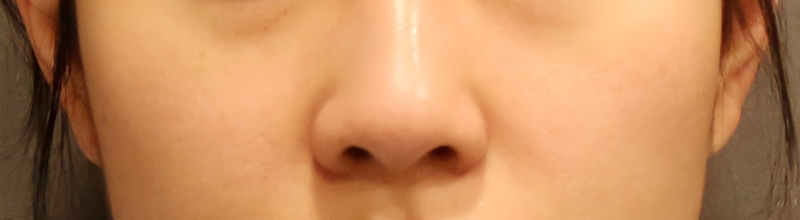 Is There a Nose Alar Reduction Surgery Without Scarring? (Looking at Before-and-After Photos) image 5