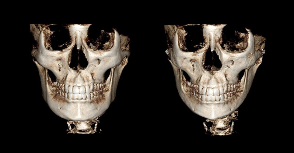 Is Pin Removal Surgery Necessary in Facial Contouring? Titanium Fixation Pins vs. Absorbable Fixation Pins image 6