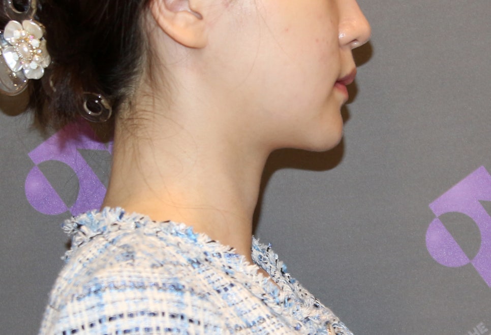 턱끝수술부작용, 이중턱이 생기는 이유는? - 전문의가 알려드립니다. 관련 이미지 8