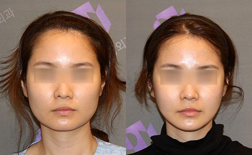 사각턱수술, 피질절골과 외측피질쉐이빙의 차이 관련 이미지 13