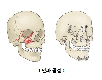 돌출눈과 함몰눈은 어떤 수술로 교정이 가능한가요? 관련 이미지 7