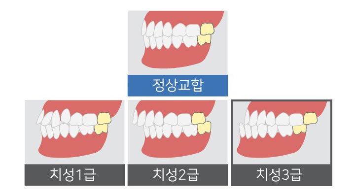 주걱턱은 어떤 수술을 해야 할까요? 관련 이미지 1