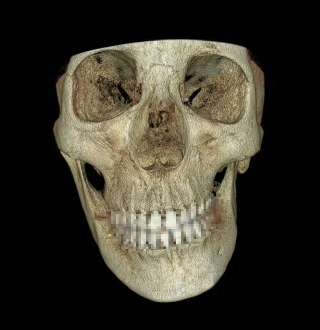 Which Surgery Do I Need: Contouring Surgery or Double-Jaw Surgery? image 5