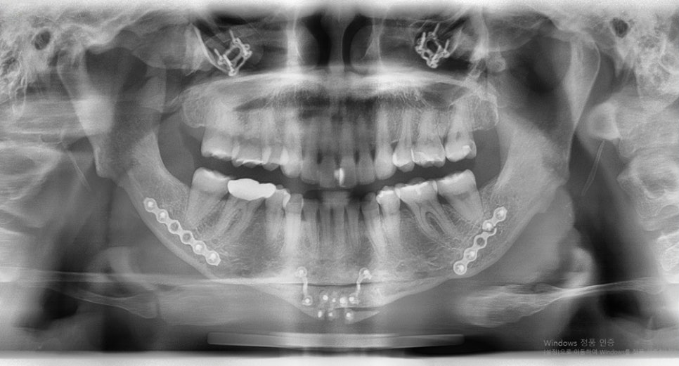 How Often Does Inflammation Occur After Facial Contouring Surgery? image 4