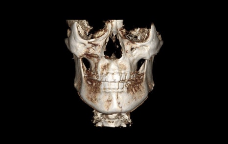 Square Jaw Surgery: What Are a Retracted Jaw and a Protruding Jaw? image 5
