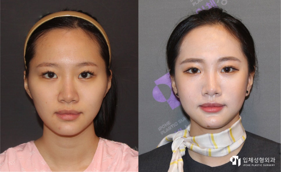 안면윤곽수술, 강남형 얼굴 피하는 법 관련 이미지 5