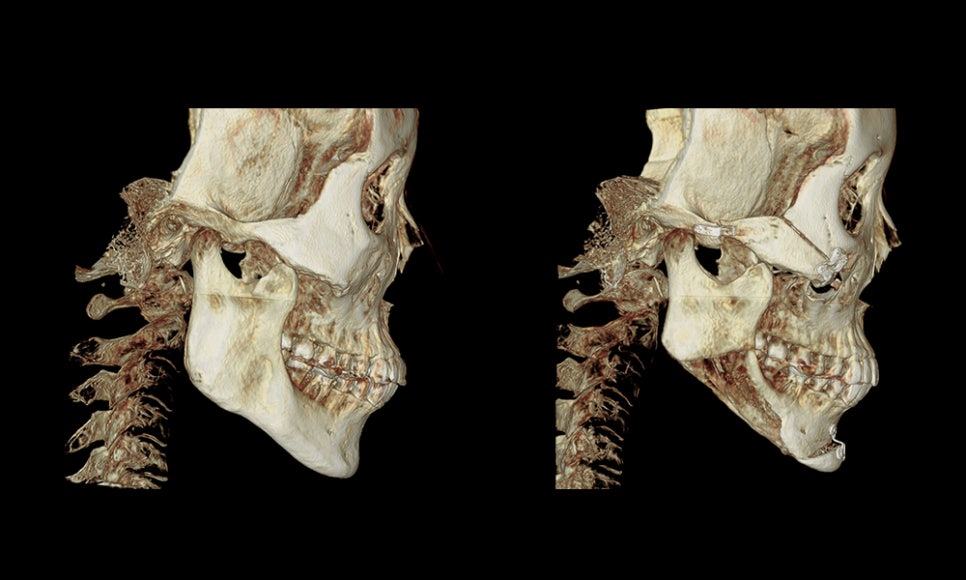 What Surgery Is Best for Correcting a Short Chin or Recessed Chin? The Limits of Chin Surgery and the Actual Results image 9