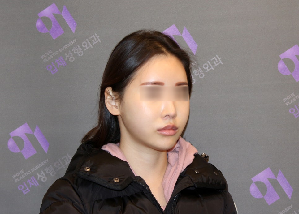 Review of Side Cheekbone Reduction Surgery image 4