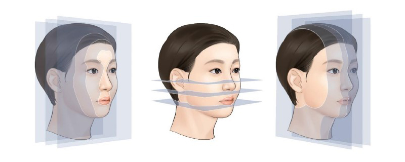 [논문 리뷰] 아시아인 안면윤곽수술에 대해서 관련 이미지 3