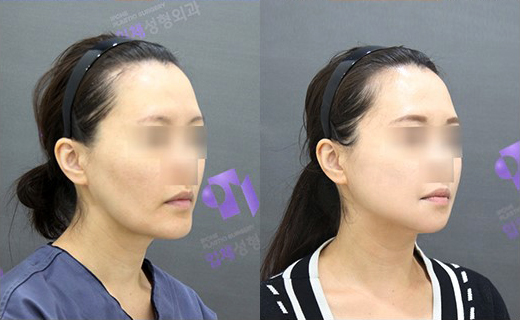 If There Is No Jaw Angle Below the Ears, Is It a “Dog Jaw”? What Is a Dog Jaw? image 10