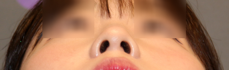 Is There a Nose Alar Reduction Surgery Without Scarring? (Looking at Before-and-After Photos) image 8