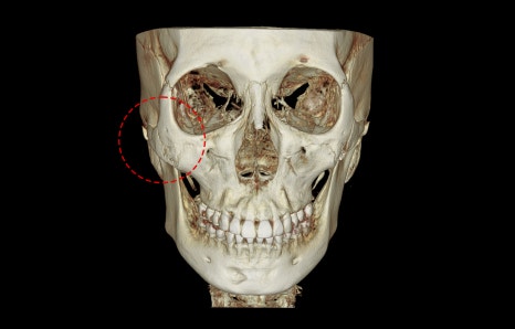 How Much Effect Does 230-Degree Zygoma Reduction Surgery Have? image 4