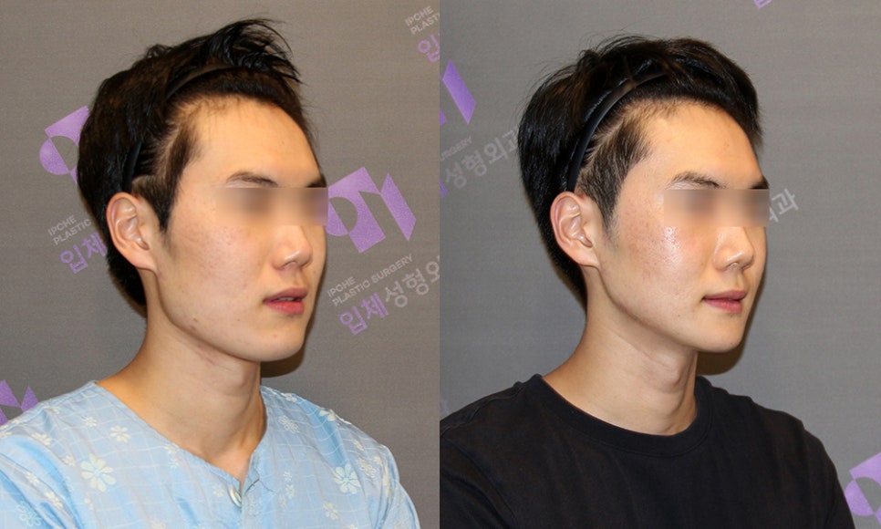Male Facial Contouring (Zygoma Surgery, Square Jaw Surgery, Chin Surgery) - Explained by a Specialist. image 6