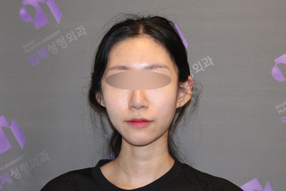 45-Degree Cheekbone Reduction Surgery Review, Let’s Look at Cases Together - Information from a Specialist image 5