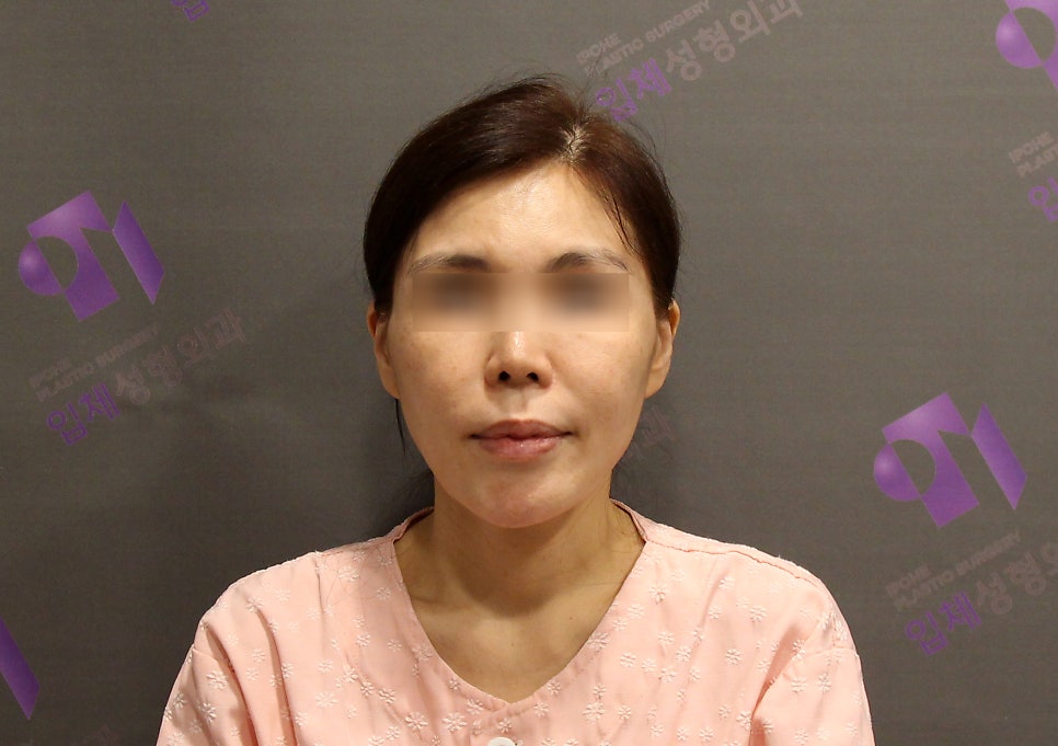 안면윤곽 볼처짐 100%온다? 광대수술 부작용 관련 이미지 2