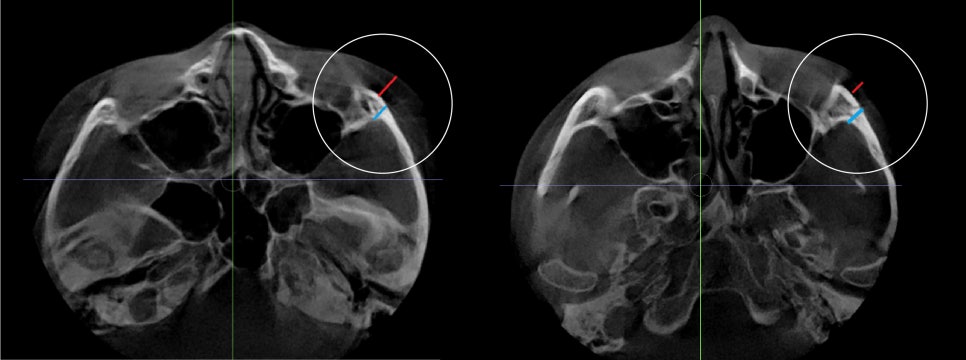 Why Cheekbones Show When You Smile, and Why Cheekbone Surgery May Not Help - Explained by a Specialist image 4
