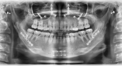 Is Pin Removal Surgery Necessary After Facial Contouring? What About Swelling and Recovery Time? image 3