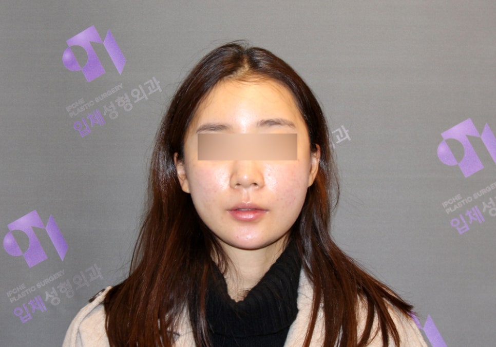 If the Face (Cheekbones) Is Asymmetrical, Can It Be Corrected with Cheekbone Reduction Surgery? image 5