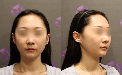 Will Jawline Surgery Make the Face’s Jawline More Defined? image 6