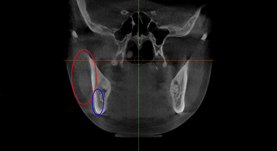 [Cube Plastic Surgery] Do You Really Need Masseter Reduction Surgery for Square Jaw Correction Surgery? - Explained by a Board-Certified Plastic Surgeon. image 1