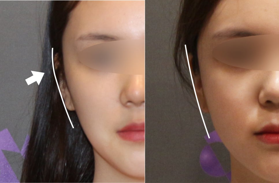 안면윤곽연예인, 연예인들은 왜 갈수록 예뻐질까요? - 성형외과 전문의가 직접알려드립니다. 관련 이미지 5