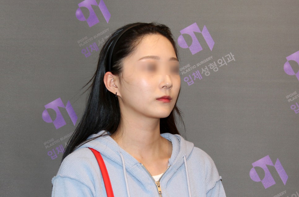 How Much Effect Does 230-Degree Three-Dimensional Zygomatic Reduction Have? image 6