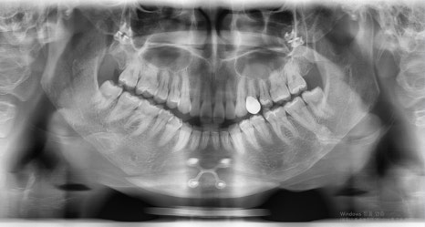 Is Pin Removal Surgery Necessary After Facial Contouring? What About Swelling and Recovery Time? image 2