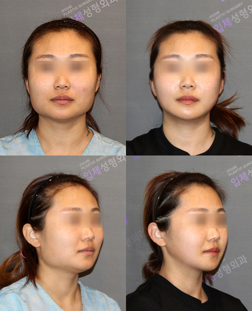 Square Jaw Surgery: What Are a Retracted Jaw and a Protruding Jaw? image 3