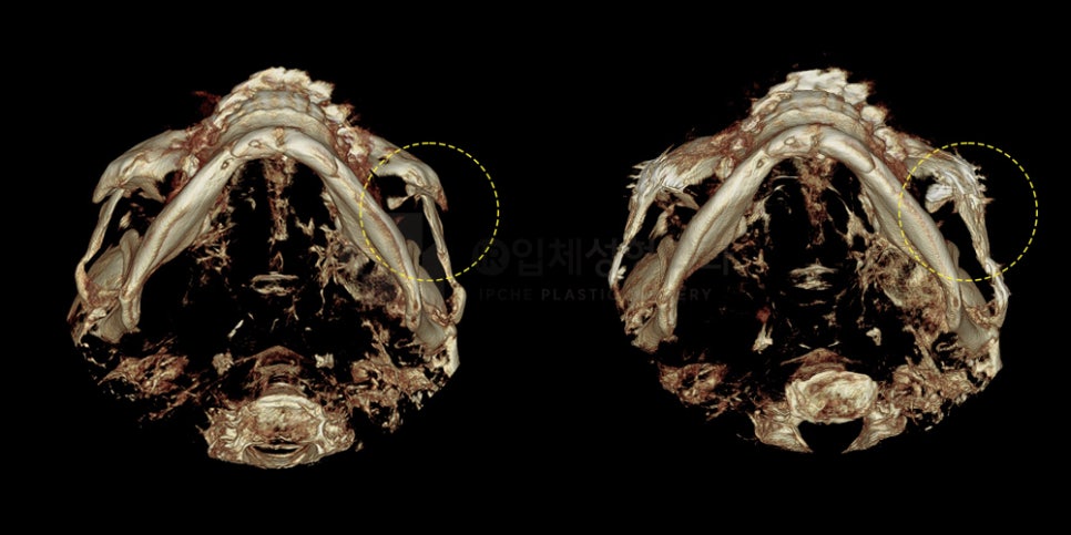 How Can a Sunken Midface Be Corrected? image 7