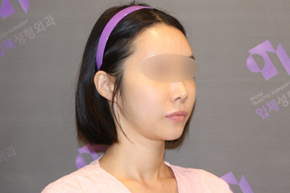 Lateral Cheekbone Reduction Surgery Review: Looking at Real Cases image 2