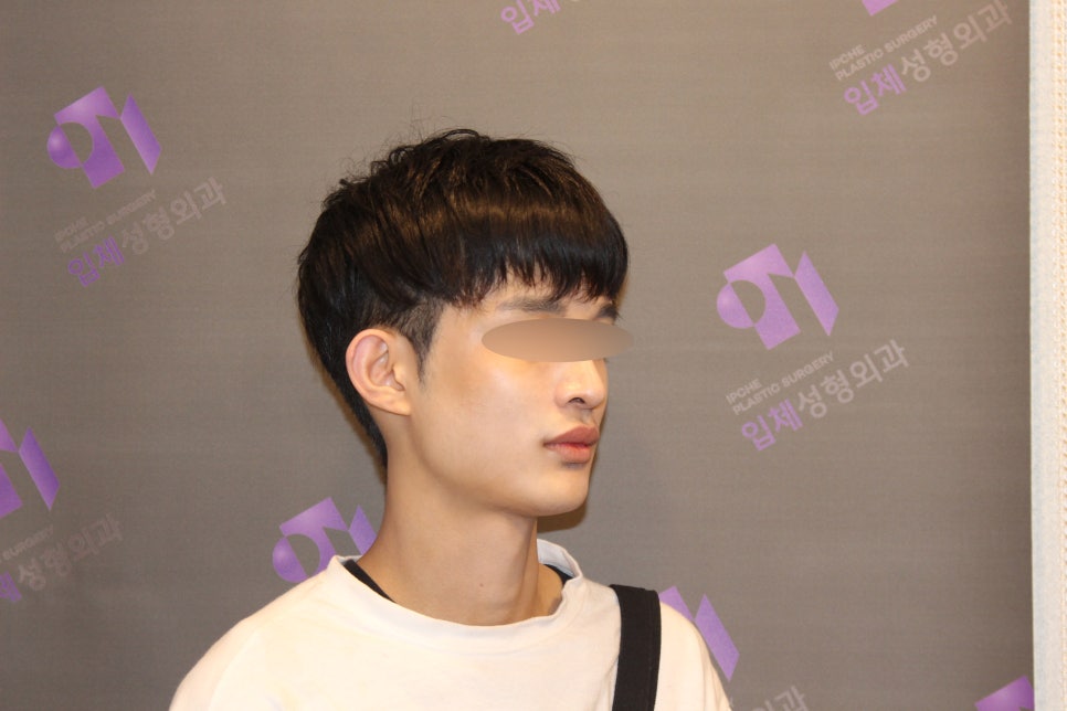 Male Facial Contouring (Square Jaw Surgery, Cheekbone Surgery, Chin Surgery) - Explained by a Specialist image 5