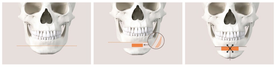 T-Genioplasty Techniques That Vary Depending on the Shape of the Chin image 5