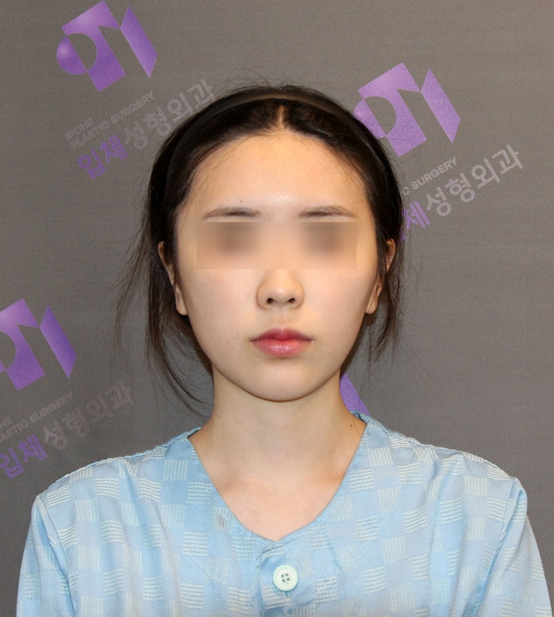 광대뼈 비대칭, 광대축소술로 교정할 수 있을까요? 관련 이미지 2