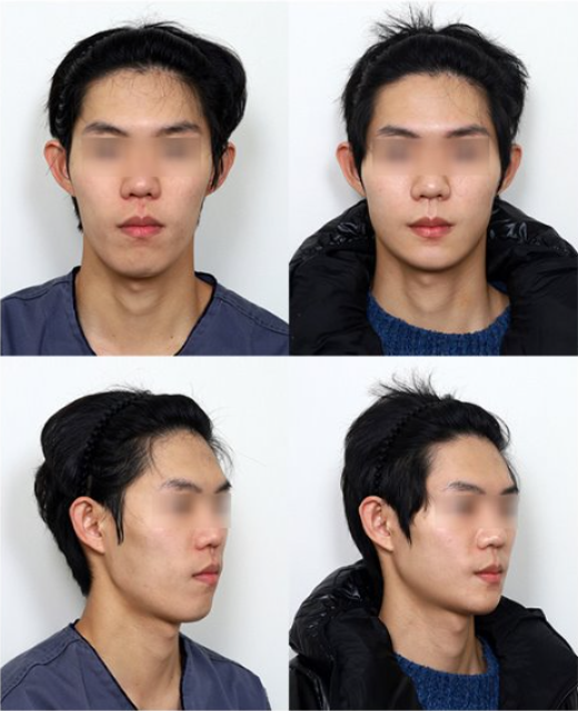 남자광대축소술이 여자와 다른 이유는? 관련 이미지 7