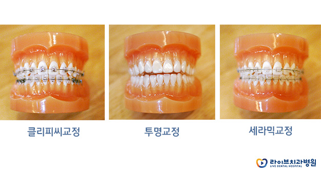 나도 부분교정이 가능할까? 관련 이미지 4