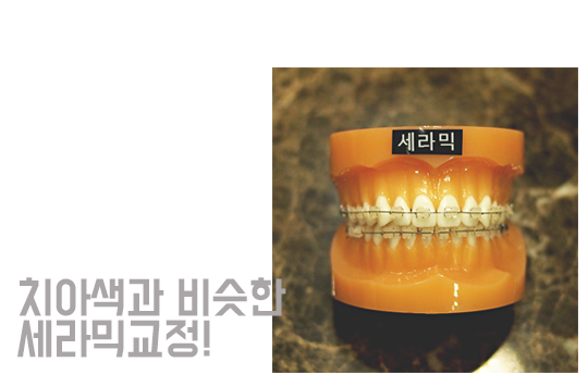 세라믹교정으로 저렴하게 심미성을! 관련 이미지 3