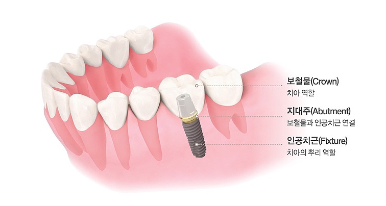 임플란트통증, 걱정없이 안전한 치료받으세요! 관련 이미지 3