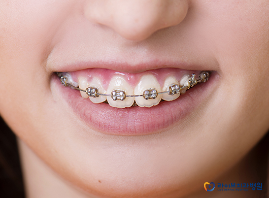 앞니교정, 부분교정으로 개선할 수 있을까? 관련 이미지 2