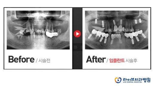 강남임플란트, 일요일치과 여기 어때요? 관련 이미지 5