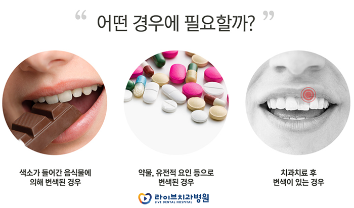 치아미백원리 어떻게 되는건가요? 관련 이미지 4