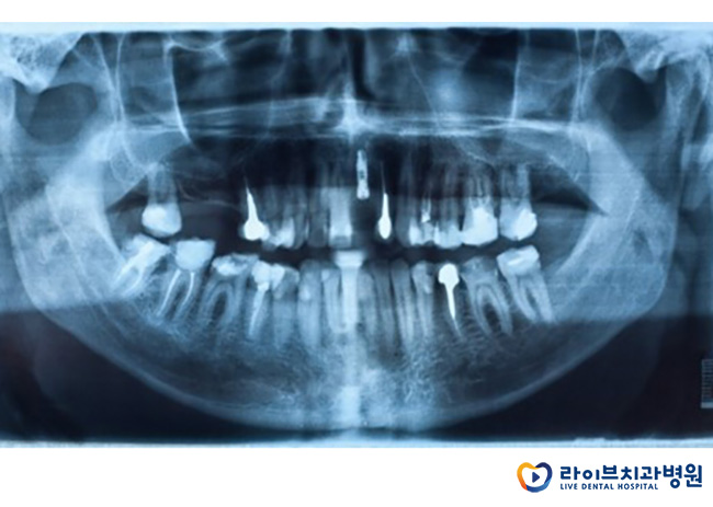 임플란트치과, 사후관리까지 꼼꼼하게 알아봐요 관련 이미지 3