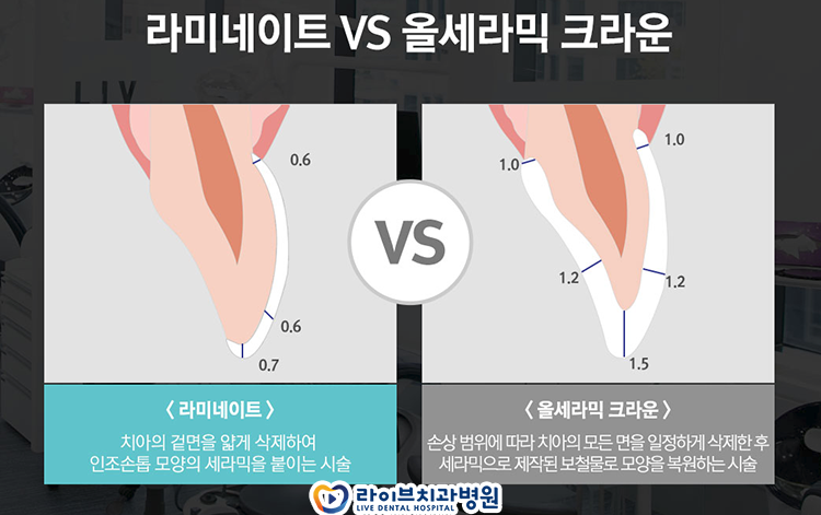 라미네이트 치료 과정이 뭘까요? 관련 이미지 3