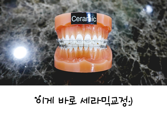 세라믹교정으로 깔끔하게 교정해요! 관련 이미지 3