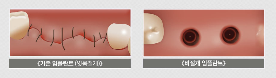 임플란트 가격과 함께 알아볼 체크사항 관련 이미지 7