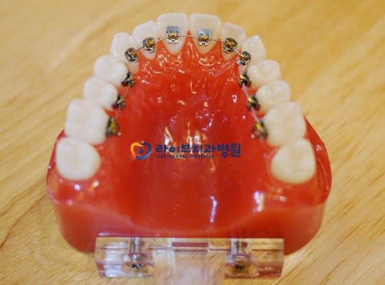 콤비교정, 위 아래 다른 스마트한 교정법! 관련 이미지 4