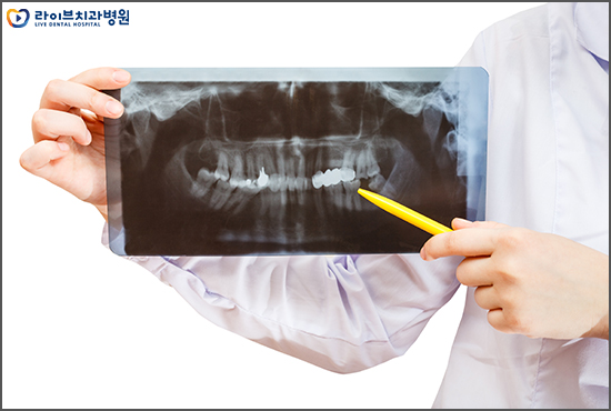 상악동거상술 궁금한 점에 대해 알아보자 관련 이미지 4