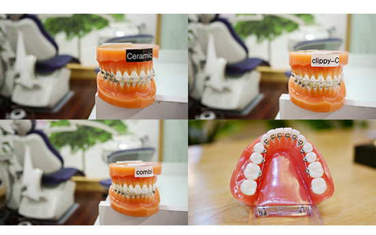 돌출입, 교정할 수 있을까? 관련 이미지 4